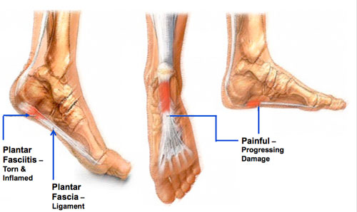 Pain in the Heel of Foot: Causes, Symptoms, Treatment